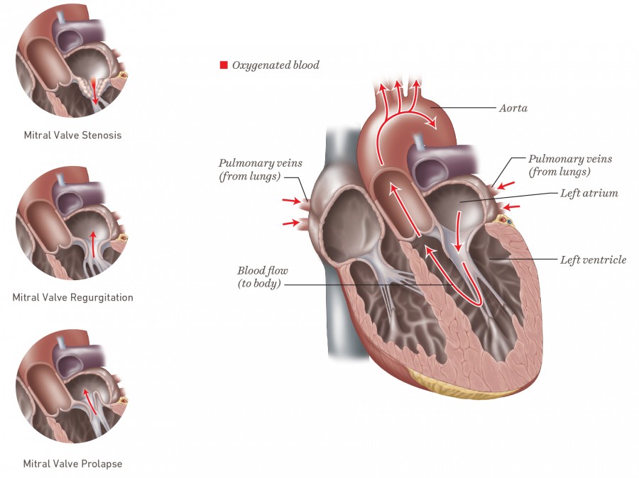 mitral-valve-disease-temple-health